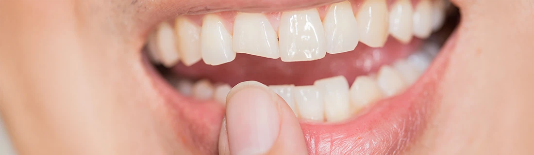 Tooth Contouring and Reshaping in Orange City FL