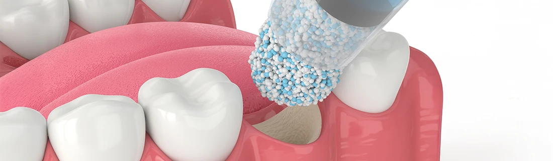 Bone Grafting in Orange City FL