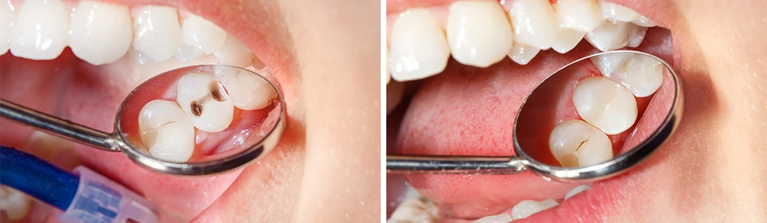 Composite Dental Fillings in Orange City FL