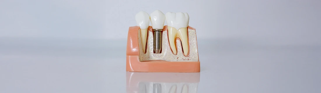 Frequently Asked Questions About Dental Implants in Orange City FL