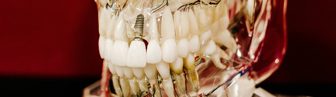 FC – Dental Implants at Premier Dentistry in Orange City, FL