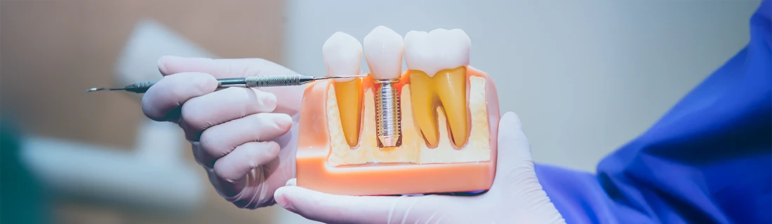 Implant Dentistry in Orange City FL