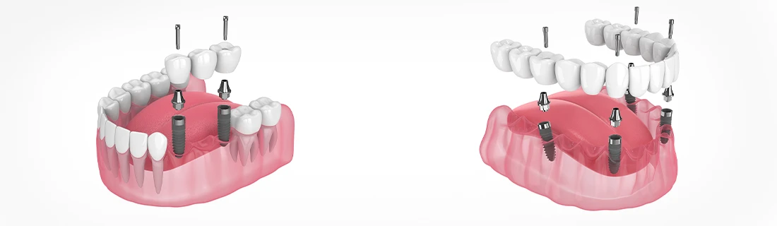 Prosthodontics in Orange City FL