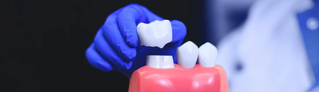 Dental Crowns in Orange City FL