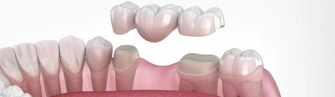 Dental Bridges in Orange City FL